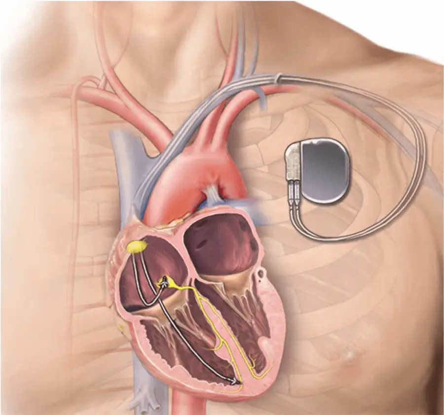 inserting-a-pacemaker-9ec40b